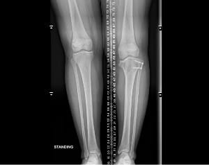 The patient's leg before corrective surgery for Blount's Disease.