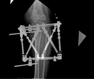 The patient's leg with the Taylor Spatial Frame device.