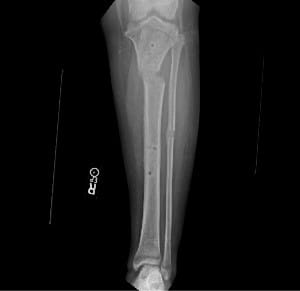 Patient's leg after corrective surgery for Blount's Disease.
