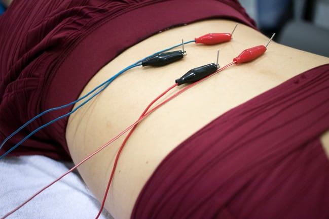 Dry Needling - Surge Mobile Physical Therapy