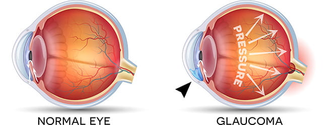 Illustration of the eye showing fluid formed that exits eye through the trabecular meshwork.