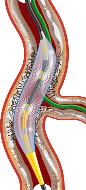 The catheter used for Intravascular Lithotripsy (IVL) system uses emitters at the end of a catheter to create pressure waves to break up calcification restricting blood flow in the vessels of the heart.