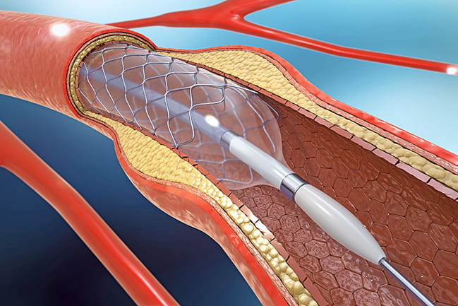 Illustration of a stent.