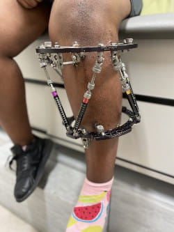 The taylor spatial frame device in a patient's leg.