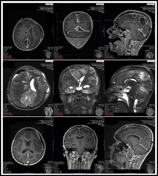 Series of scans showing progression of bacterial brain infection. Top row: scan indicates pockets of pus in brain  Middle row: scan shows skull after over 12 surgeries and half of the skull was removed and brain was drained. An induced COMA due to brain pressures that would normally kill a patient.  Bottom row: scan shows complete recovery, patient walking around and out of rehab. 