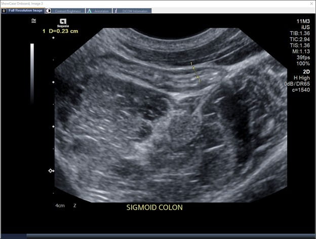 Normal appearing sigmoid colon with normal bowel wall thickness on IUS.