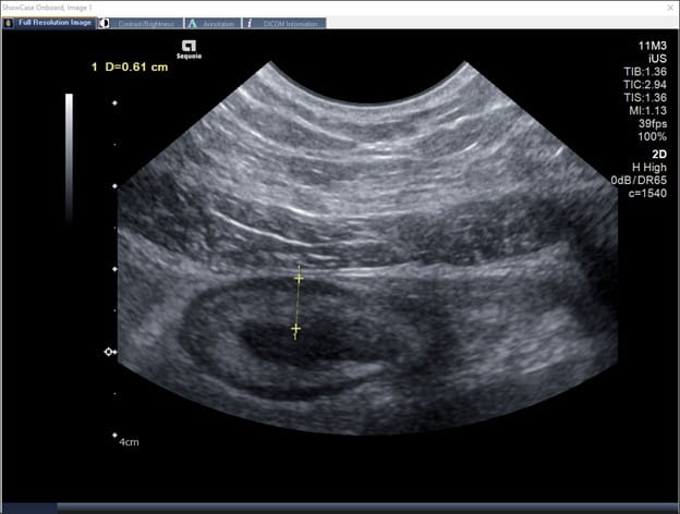 Sigmoid colon with increased bowel wall thickness on IUS consistent with active colitis.