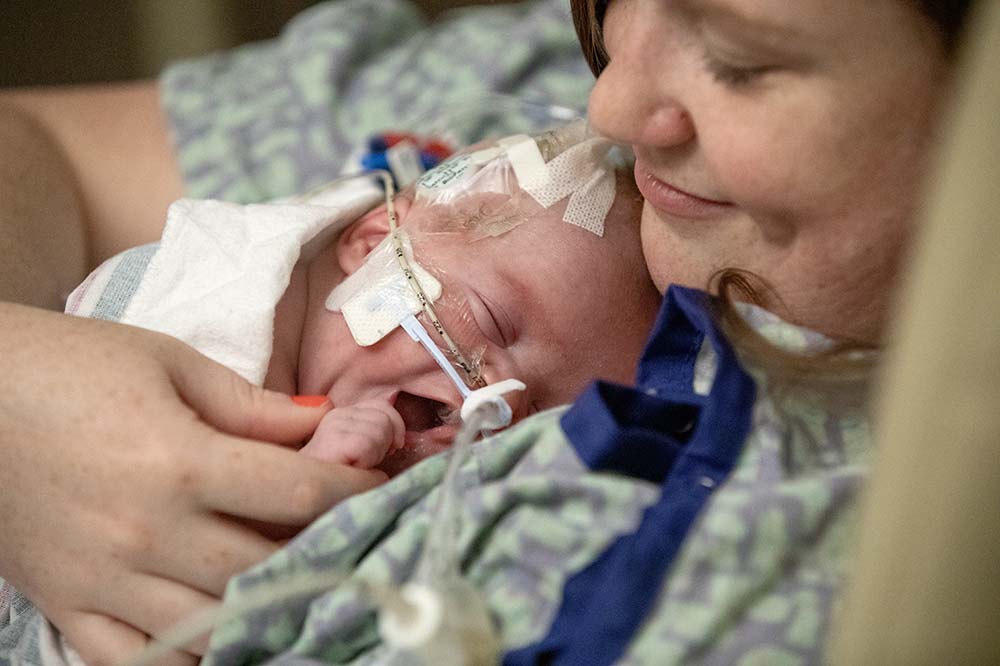 Closeup of baby's face as he yawns. He has tubes and gauze on his face. He is lying on the chest of a smiling woman.